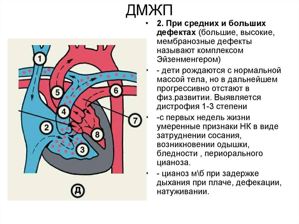 Дефект межжелудочковой перегородки у новорожденного в сердце - последствия и лечение мышечного ДМЖП
