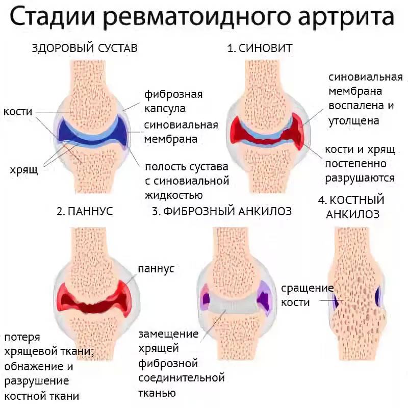Причины артрита коленного сустава у детей, симптомы, диагностика и лечение
