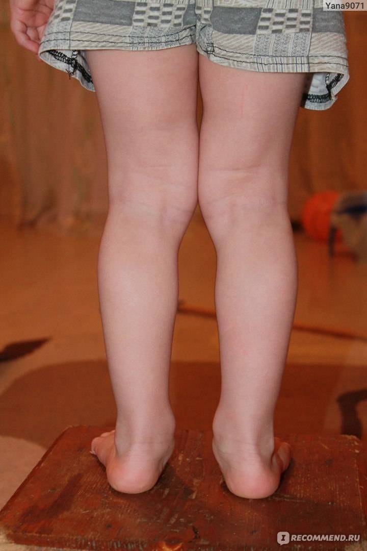 Деформация стопы у детей - лечение вальгусной и варусной деформации в клинике санкт-петербурга