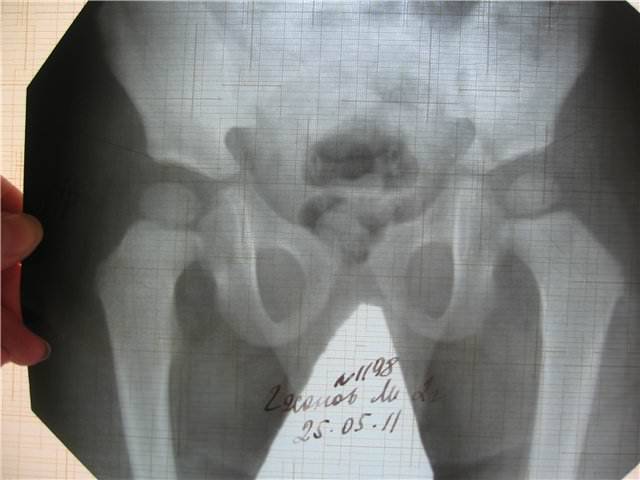 Рентген при планировании беременности: можно ли делать рентгенографию зуба, ноги и прочего?