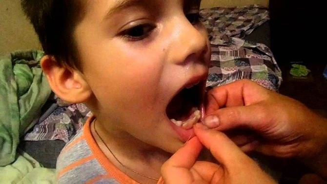Как выдернуть молочный зуб в домашних условиях
