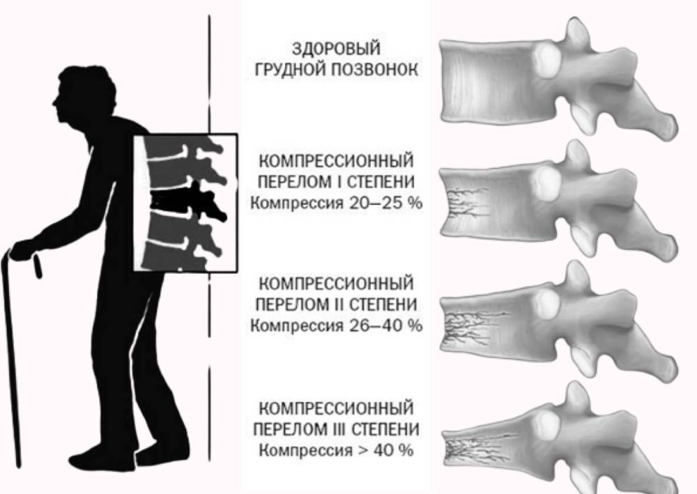 Лфк при компрессионном переломе позвонка в области грудного и поясничного отделов позвоночника