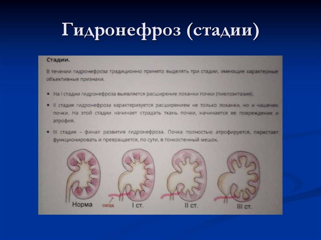 Рак почки