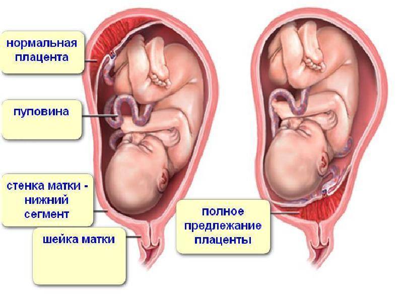 Низкая плацентация при беременности: симптомы, чем грозит и как лечить
