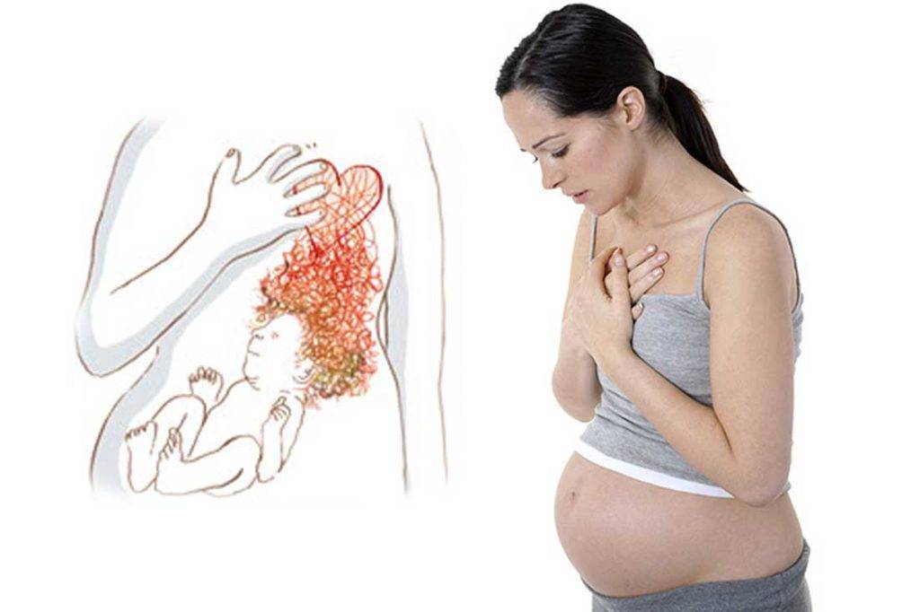 Изжога при беременности - причины, диагностика, профилактика и лечение патологии