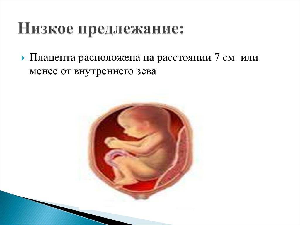 Чем грозит краевое, полное (центральное) предлежание плаценты и как эта патология беременности отражается на родах