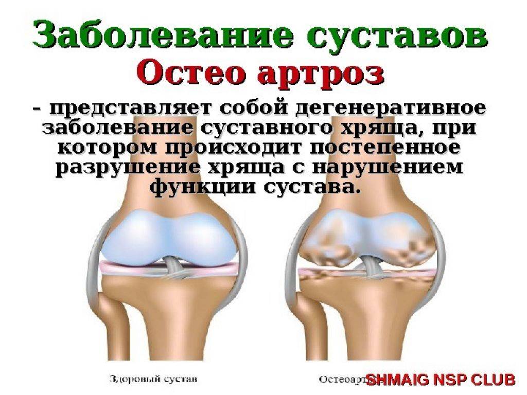 Заболевание поражение суставов. Деформирующий остеоартроз синовиальная жидкость. Заболевания суставов коленей. Болезнь суставов название. Поражение коленного сустава.