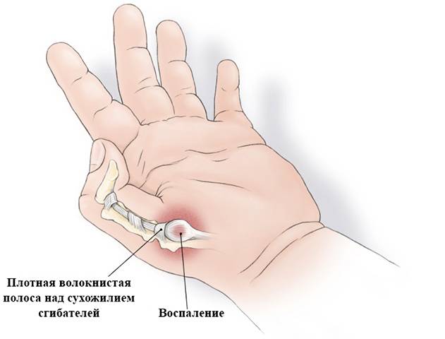 Безоперационное лечение щелкающего пальца (болезнь нотта) - estetik international | aesthetic plastic surgery estetik international | aesthetic plastic surgery
