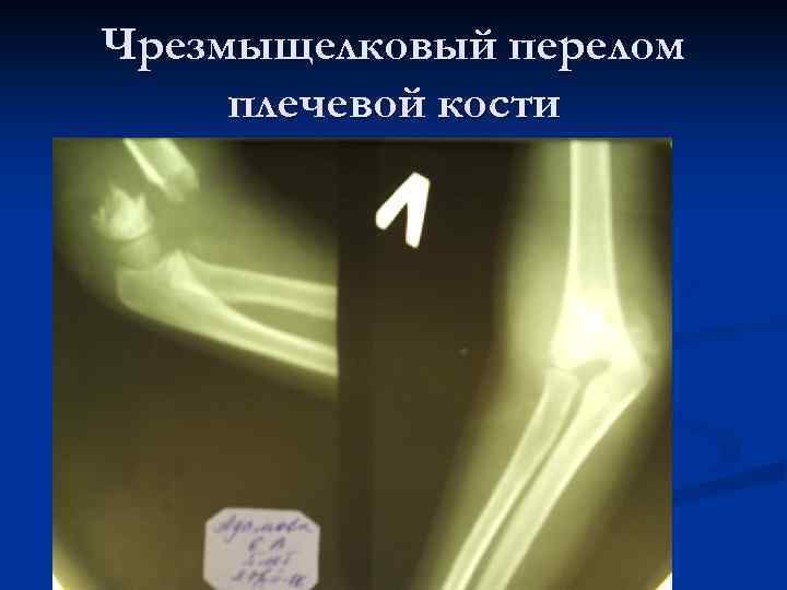 Особенности регенерации костной ткани при лечении переломов дистального
отделе бедренной кости методом чрескостного остеосинте