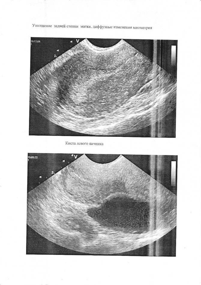 Гипертонус матки при беременности - медицинский портал eurolab