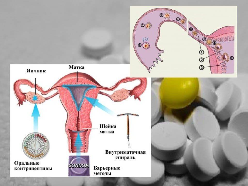 Противозачаточные таблетки и беременность - возможности и последствия | аборт в спб