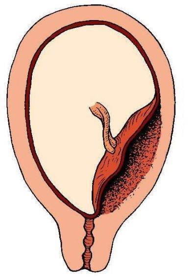 Плацента по передней стенке – что это значит, как еще может быть расположен орган в матке?