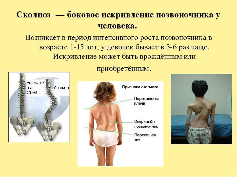 Сколиоз у детей - причины, лечение и профилактика