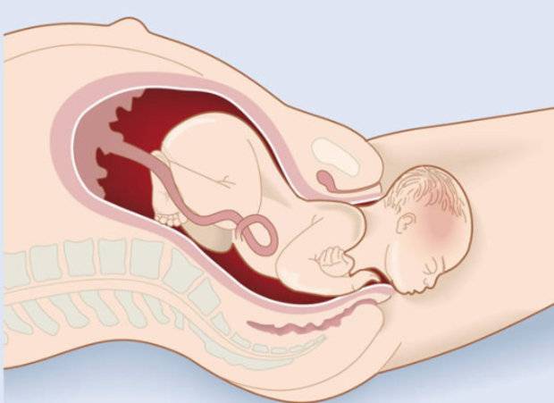 Роды после снятия акушерского пессария: через сколько начинаются схватки и когда можно родить?