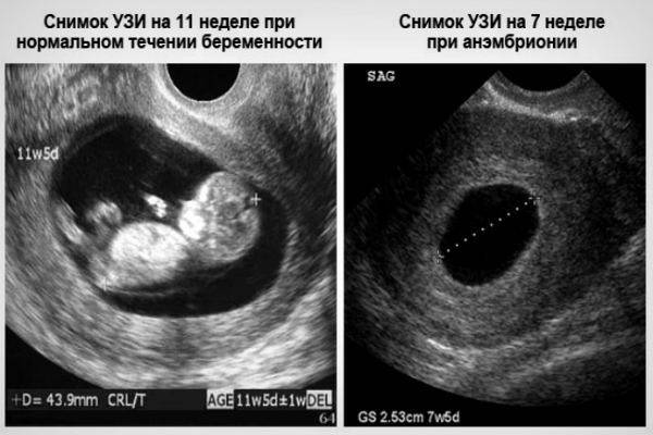 Фото узи замершей беременности