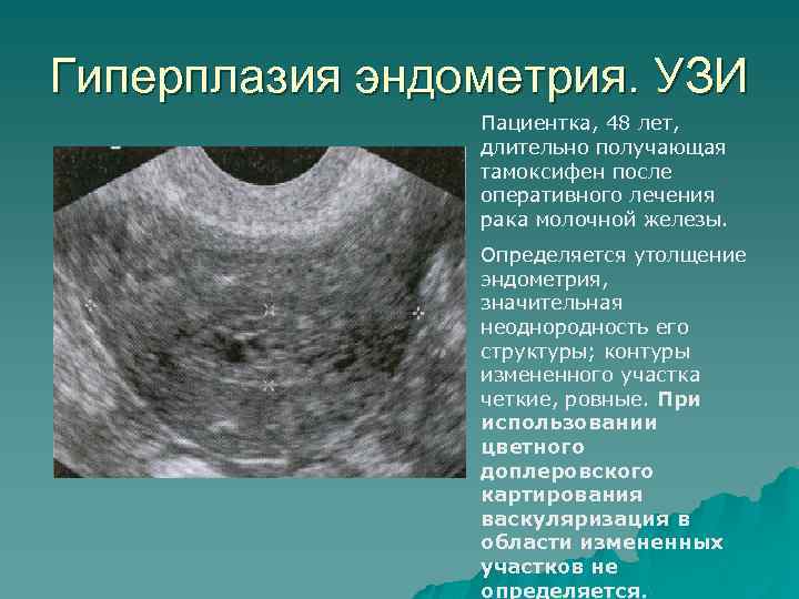 Абляция эндометрия матки