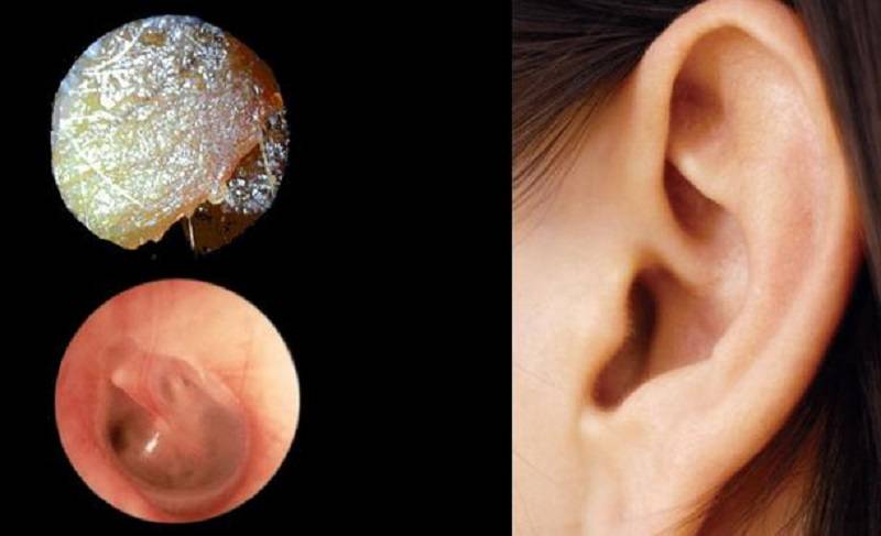 ᐈ откуда берется ушная пробка и что делать если много серы в ушах?