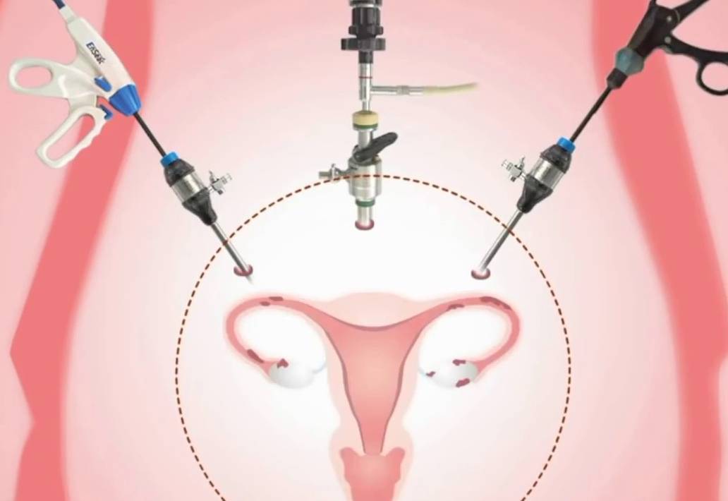 Удаление кисты яичника: как подготовиться к операции  - статья репродуктивного центра «за рождение»