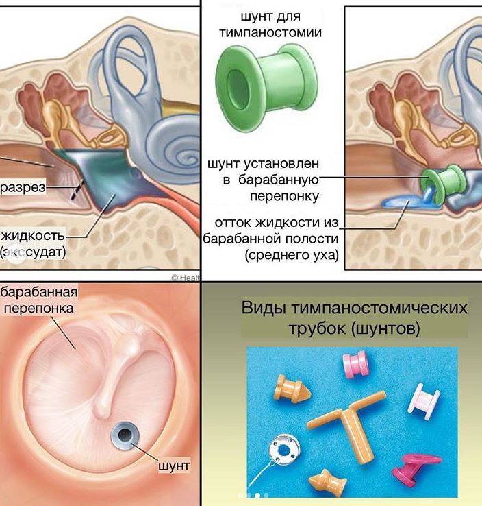 Лечение гнойного отита у взрослых, как лечить хронический отит среднего уха препаратами