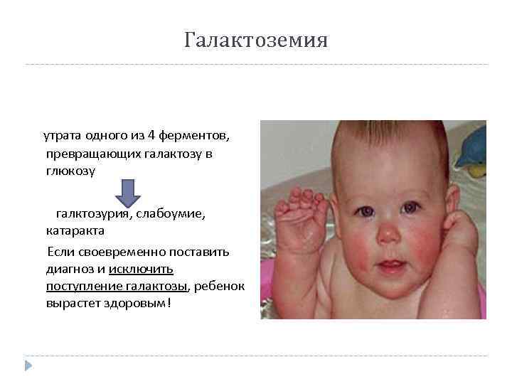 Галактоземия: признаки, лечение, рекомендации — онлайн-диагностика