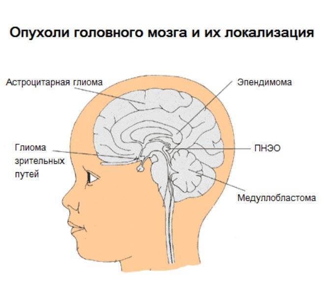 Симптомы опухоли головного мозга на ранних стадиях, первые признаки рака головного мозга