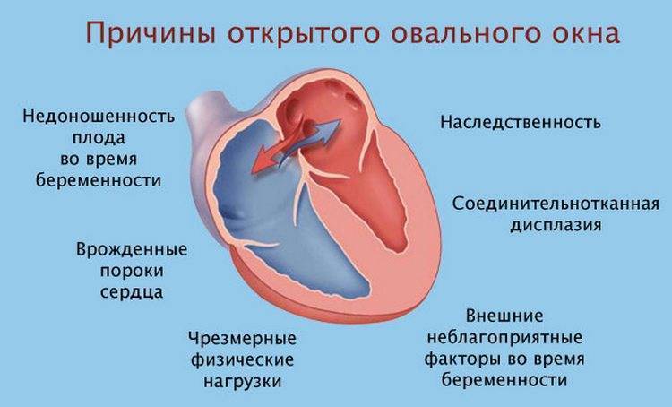 Что такое открытое овальное окно в сердце у новорожденных, когда оно должно закрыться?