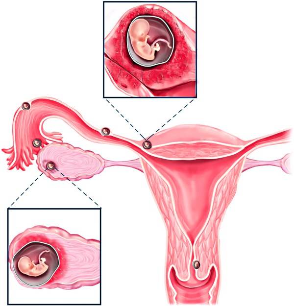 Загиб матки и беременность, позы для зачатия. советы гинеколога.