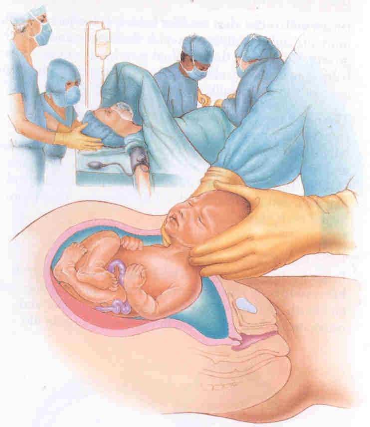 Через сколько после снятия пессария начинаются роды? могут ли начаться преждевременные роды, если стоит пессарий?