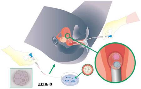 Подготовка к криопереносу эмбрионов: какой метод лучше