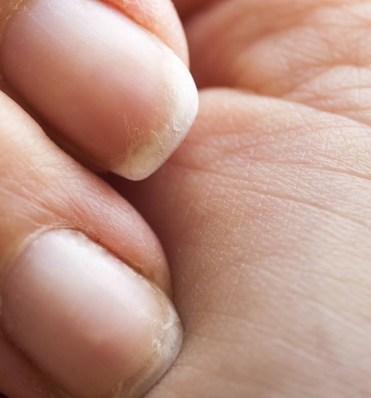 Как укрепить ломкие ногти