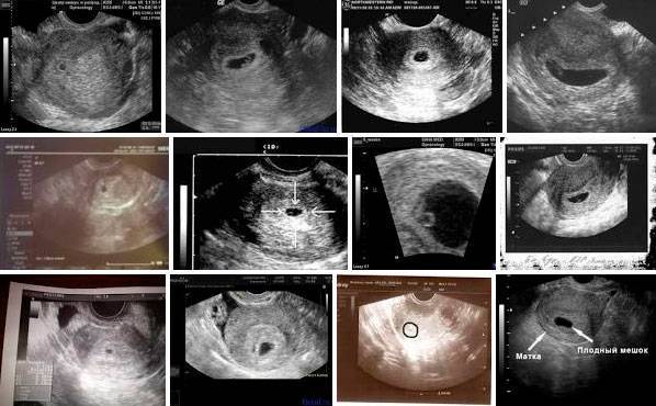 Беременна или нет? узи покажет 5 причин отсутствия эмбриона