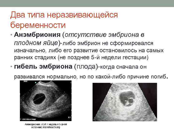 Пустое плодное яйцо или анэмбриония: причины, симптомы и методы диагностики отсутствия эмбриона