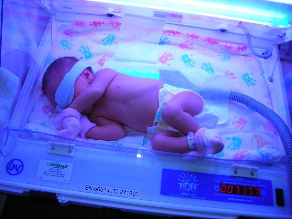 Лечение желтухи новорожденного в домашних условиях
