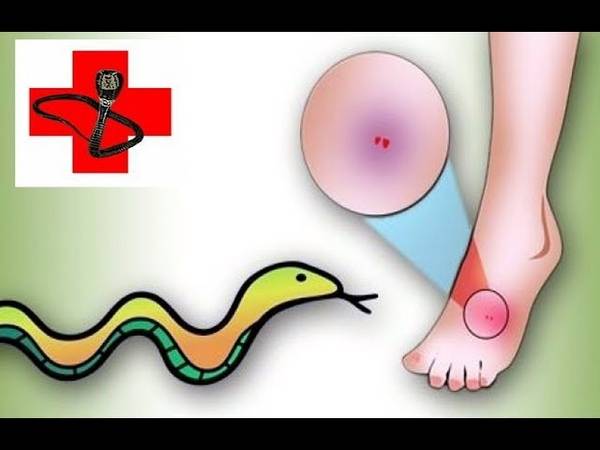 Первая помощь при укусе змеи: алгоритм оказания | food and health