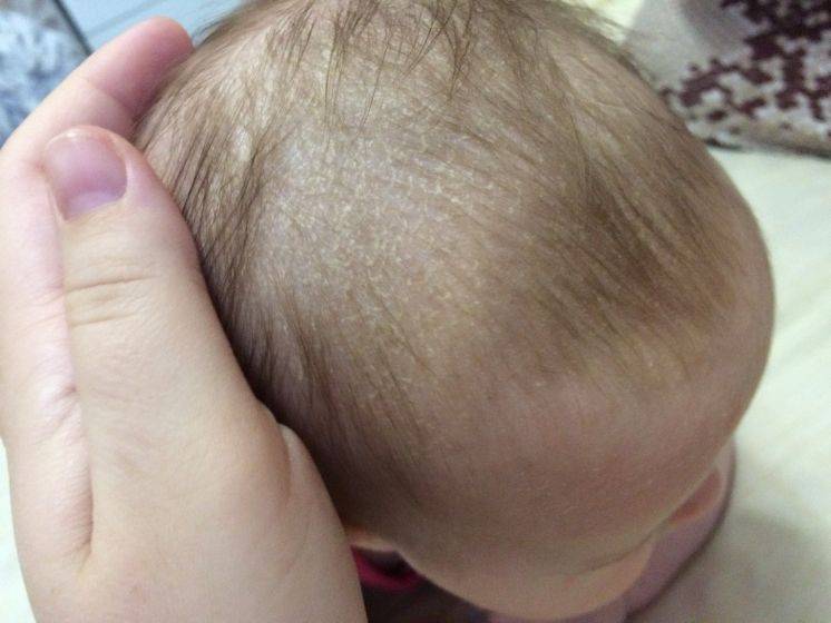 ᐈ выпадение волос у детей: причины и методы лечения