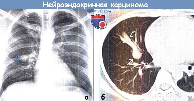 Кт или рентген легких: что лучше?