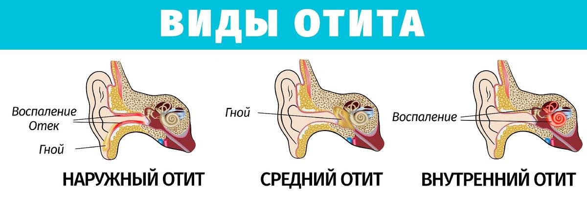 Отит у детей: симптомы и лечение воспаления среднего и наружного уха в домашних условиях