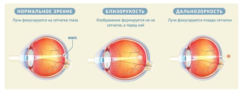 Фокусировка глаза человека. Миопия схема глаза. Нормальное зрение близорукость дальнозоркость схема. Что такое близорукость (миопия) и дальнозоркость (гиперметропия). Форма глаза при близорукости и дальнозоркости.