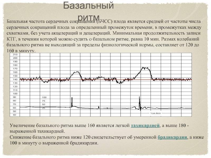 Как определить синдром дауна у плода