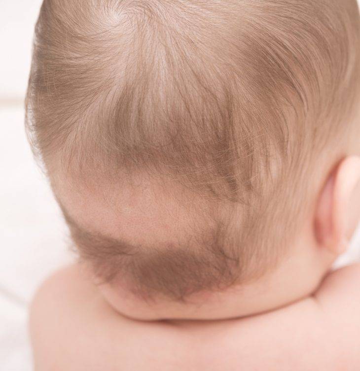 У ребенка нет волос на голове: в чем причина?