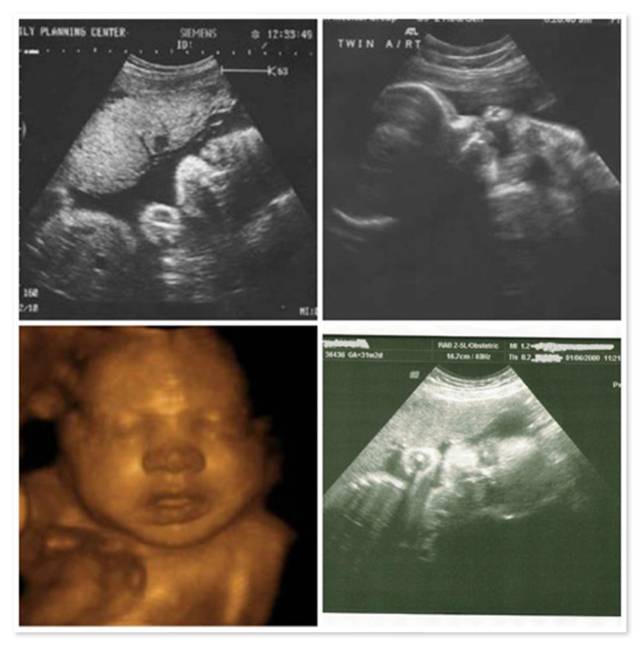 34 недели беременности что происходит с малышом и мамой
