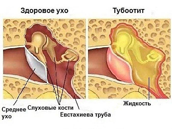 Хронический тубоотит. Тубоотит барабанная перепонка. Двухсторонний тубоотит.