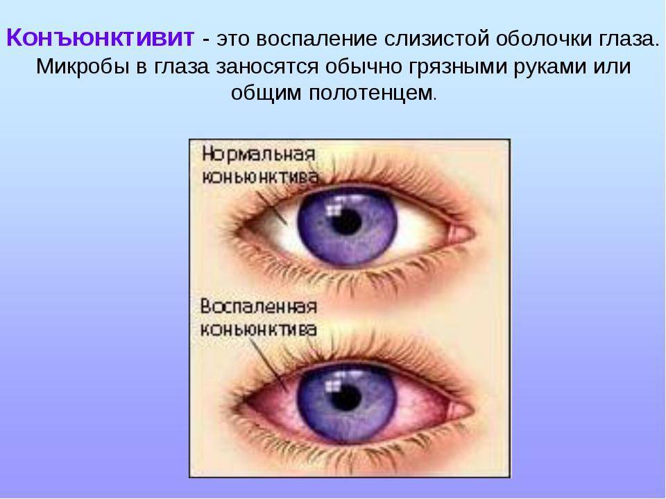 Вирусный конъюнктивит у детей: лечение заболевания глаз, симптомы с фото
