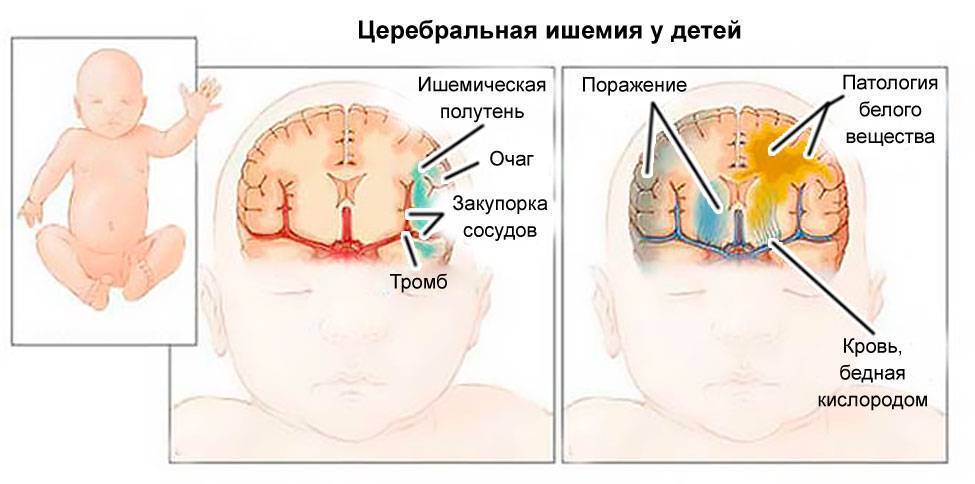 Незрелость коры головного мозга ребенка лечение