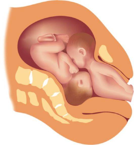 Редукция эмбрионов: что это такое и когда проводят?