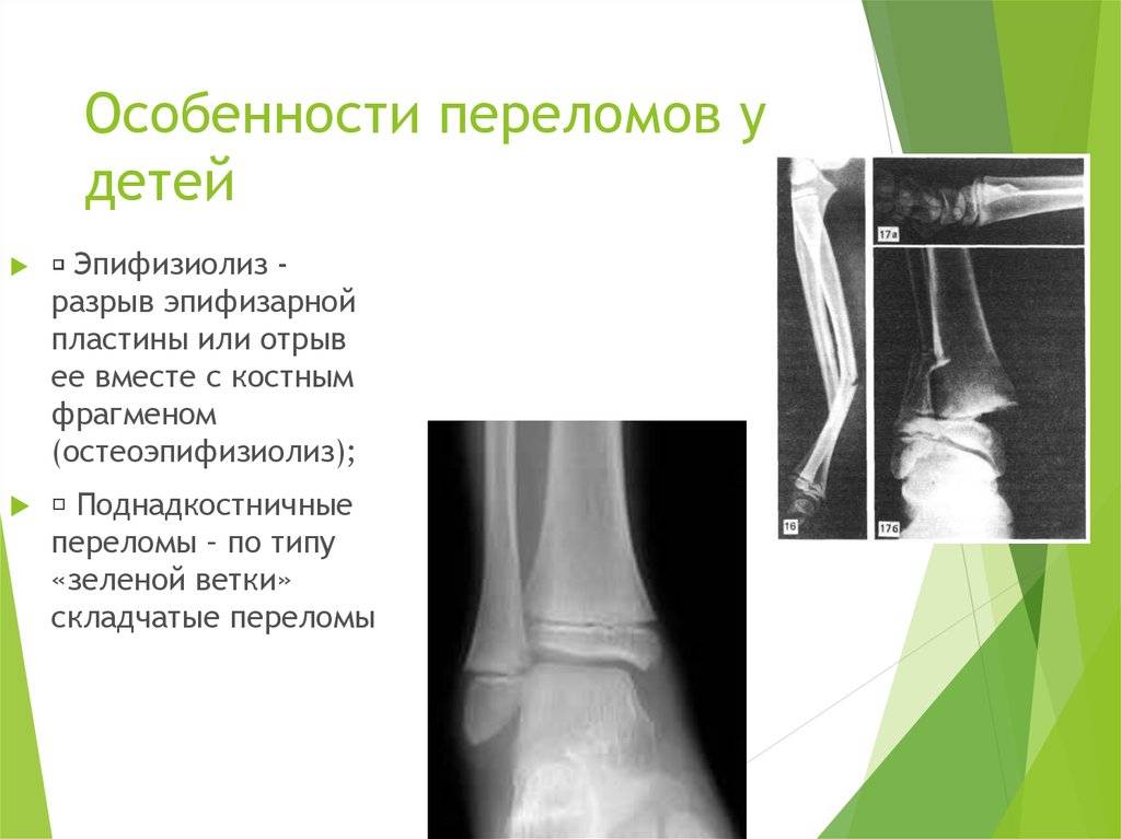 Переломы плечевой кости у детей - признаки, причины, симптомы, лечение и профилактика - idoctor.kz