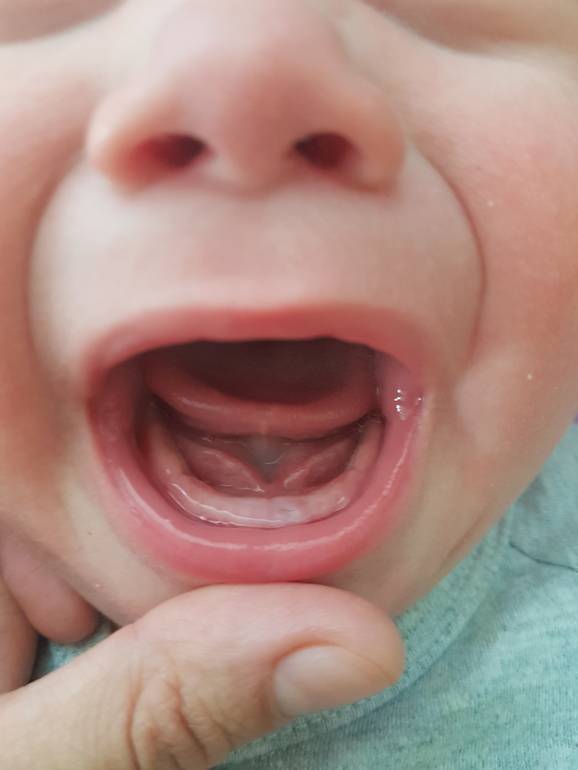 Прорезывание молочных зубов у детей: сроки, схема, порядок появления