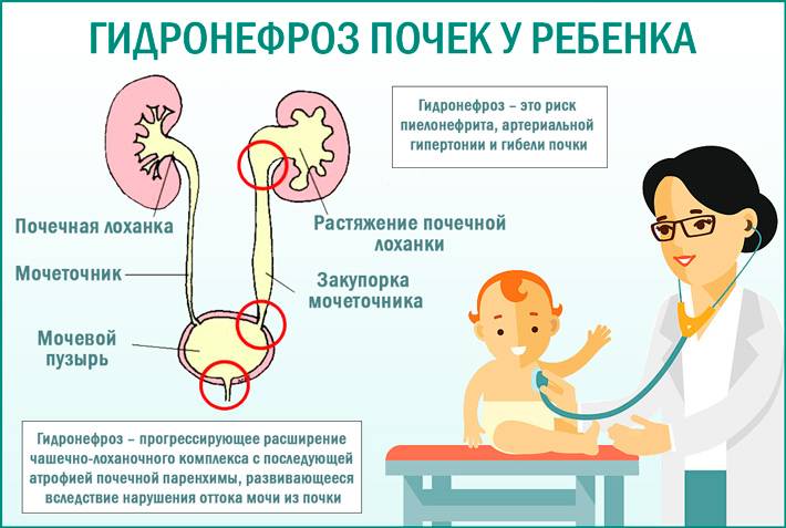 Гидронефроз у плода, новорожденных и детей