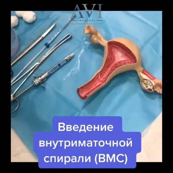 Удаление внутриматочной спирали: платные услуги врача-гинеколога в москве