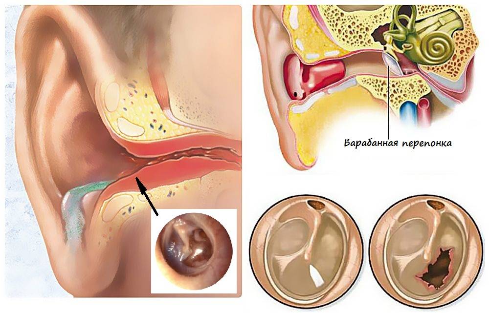 Острый тубоотит (евстахиит) у детей, причины, диагностика, лечение